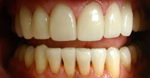 Veneers, Straightening – After Picture 