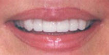 Crowns, Veneers, Bonding – After Picture