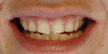 Dental Implants, Crowns – Before Picture 