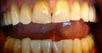 Veneers, Straightening – Before Picture 