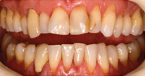 Veneers, Straightening, Bonding – Before Picture 