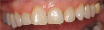 “ Veneers – Before Picture 