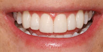 Porcelain Veneers – Before Picture