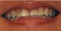 Veneers, Crowns, Bonding – Before Picture