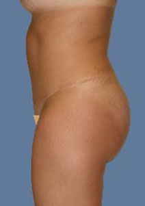 Tummy Tuck – Before Picture – Side 