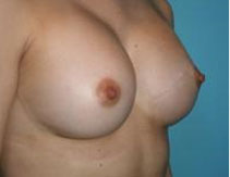Breast Implants – After Picture  - Side