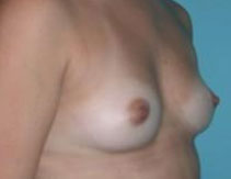 Breast Implants – Before Picture - Side