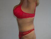 Tummy Tuck – Before Picture – Left Side