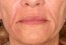 Facial Fillers – Before Picture 