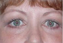 Eye Enhancement – Before Picture 