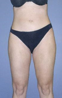 Liposuction – After Picture – Front 