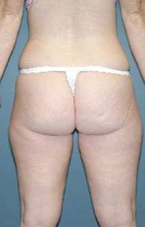  Liposuction – After Picture – Back