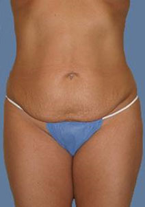 Tummy Tuck – Before Picture – Front 